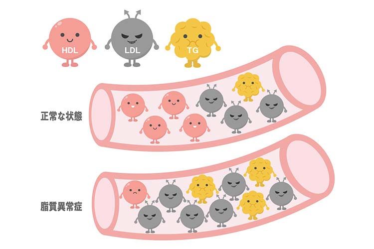 脂質異常症